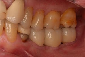 インプラント術後