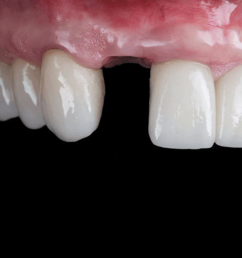 インプラントの特徴|メリット|インプラントとは