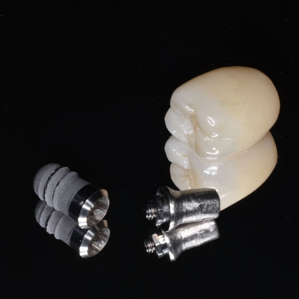 インプラントセラミックス|インプラントオススメ