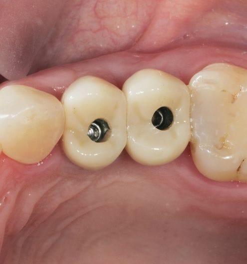 インプラントの特徴|メリット|インプラントとは