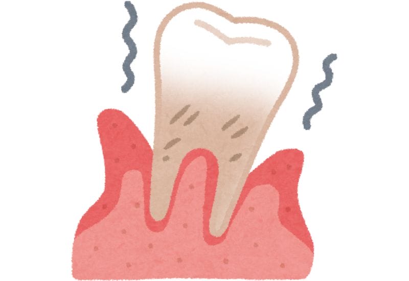 歯周病