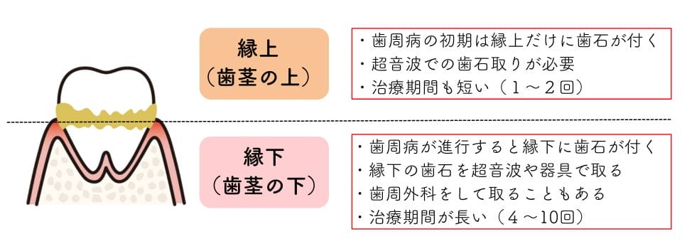歯周病プロフェッショナルケア 歯周病治し方 歯医者
