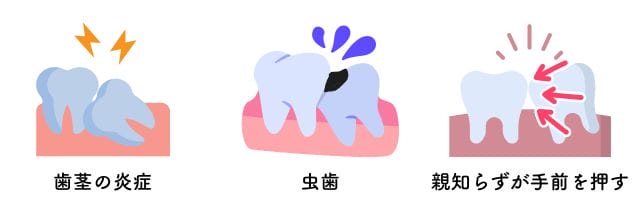 抜歯する理由