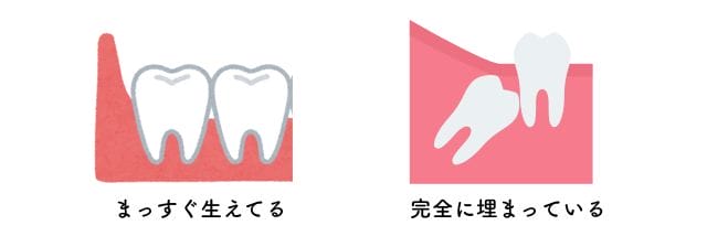 抜歯しない理由