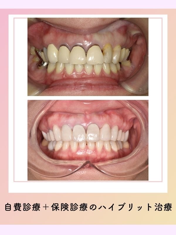 日立市　歯医者｜症例写真｜審美治療