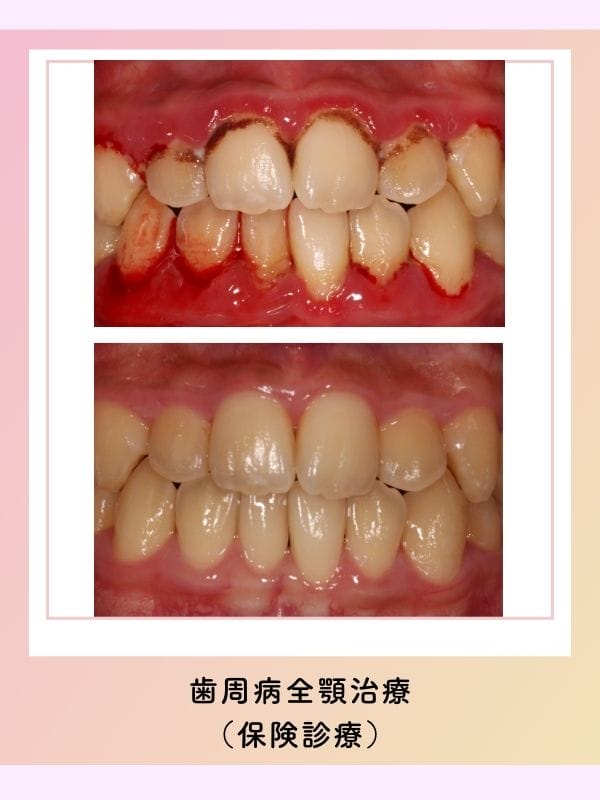 日立市　歯医者｜歯周病治療｜症例写真